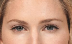 sandra_front_after botox (800×498)