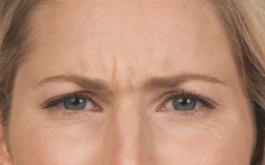sandra_front_before Botox (800×498) (800×498)
